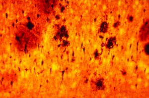 Alzheimer's Disease Brain Alzheimers-Brain1-300x198