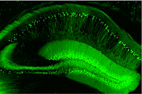 Downsyndrome2_2_LD